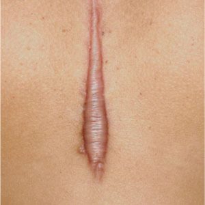 cicatrices chéloïdes microneedling albi