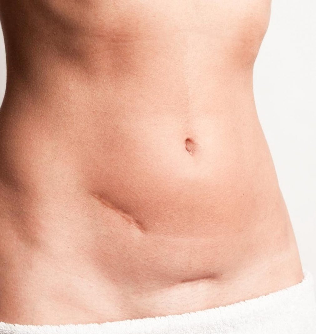 microneedling cicatrices