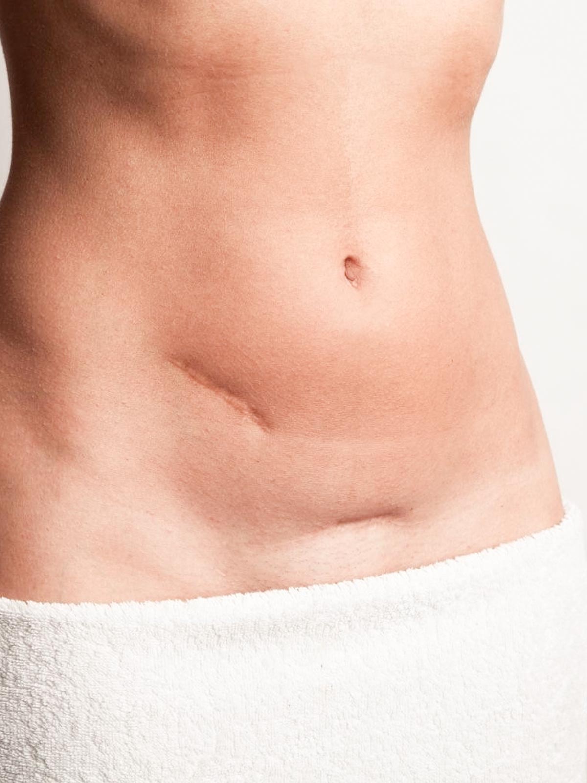 microneedling cicatrices