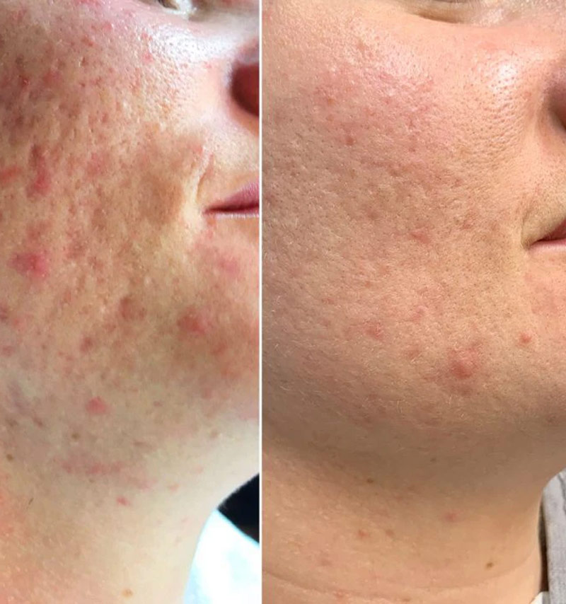 microneedling cicatrices acné