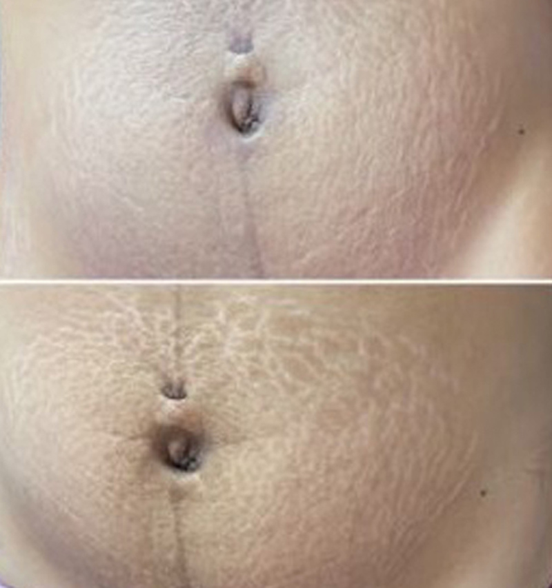 microneedling cicatrices vergetures tarifs