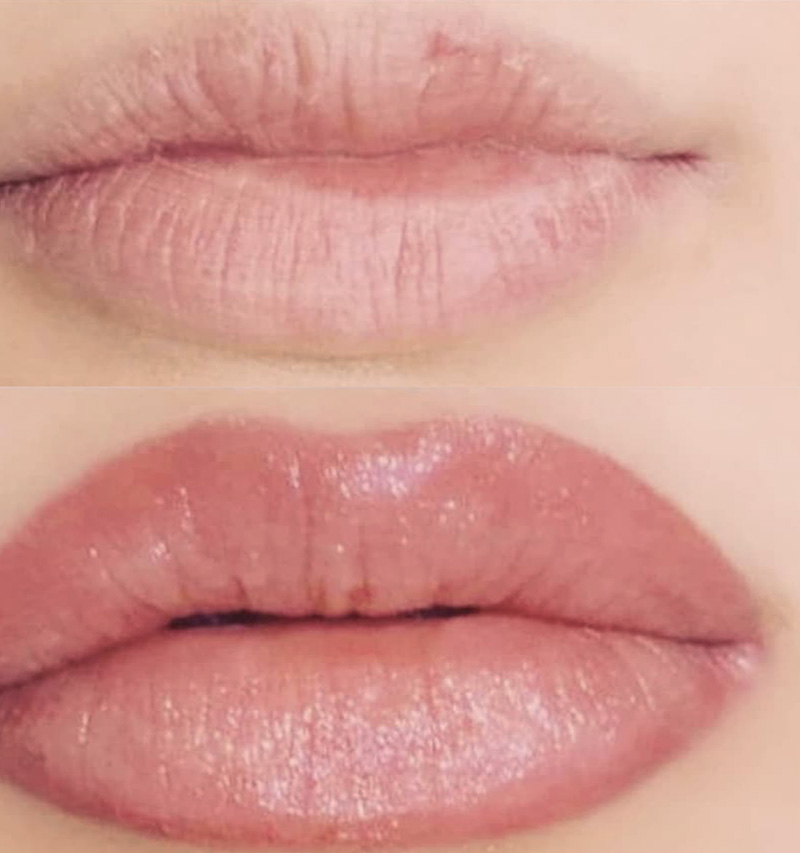 pigmentation lèvres dégradé avant après