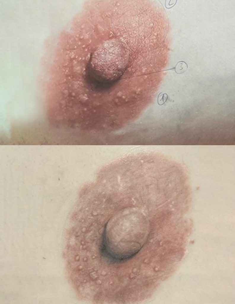 reconstruction areoles mammaires 3d