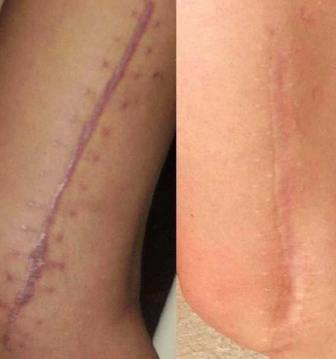 dermopigmentation reparatrice cicatrices