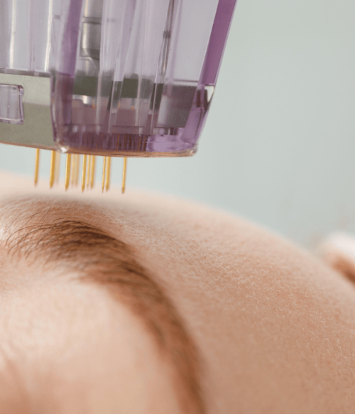microneedling capillaire ou Hair needling