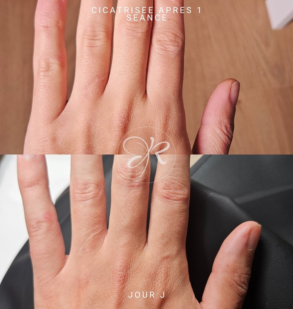 avant après camouflage cicatrices sans pigments
