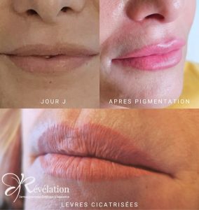 résultat maquillage permanent des lèvres avant/après et cicatrisé sur lèvres déjà tatouées- institut révélation albi