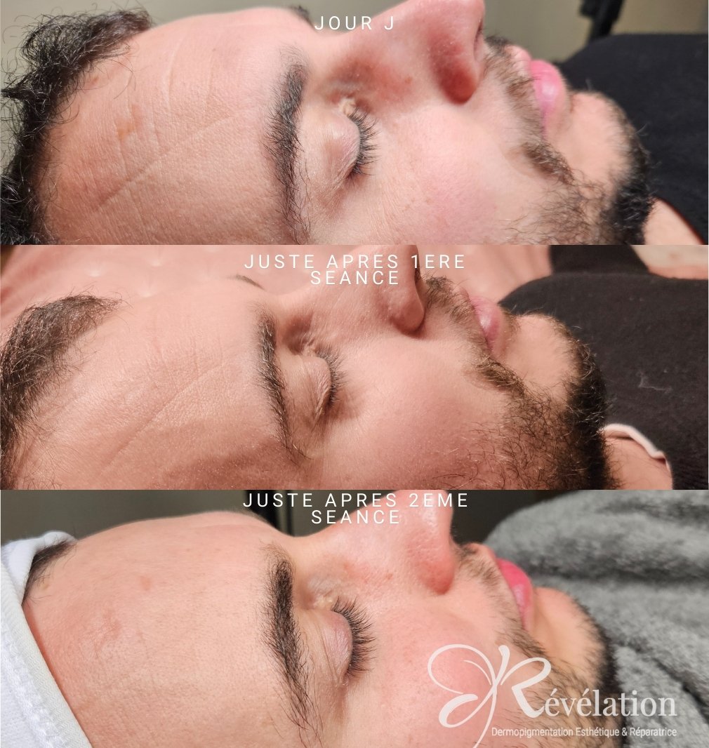 soin anti rides microneedling- révélation albi
