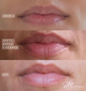 soin des lèvres microneedling albi- révélation
