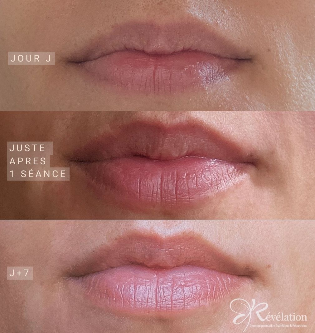 microneedling lèvres