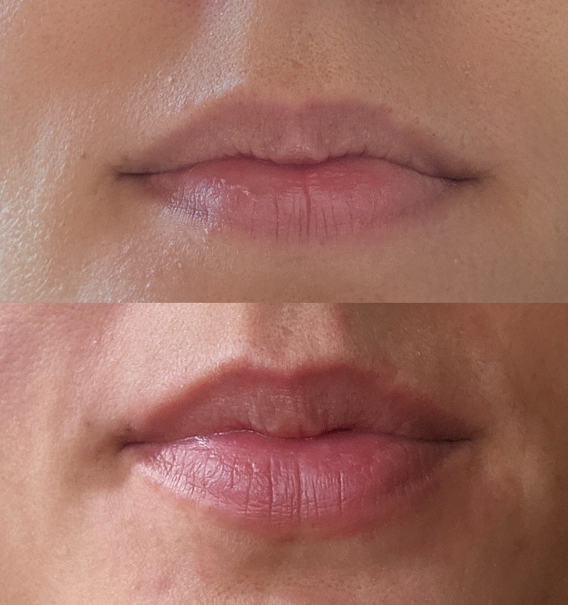 avant après microneedling des lèvres