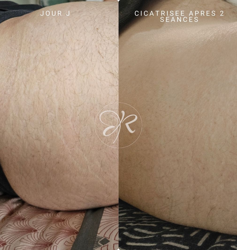 résultat avant après camouflage cicatrices albi MICRONEEDLING