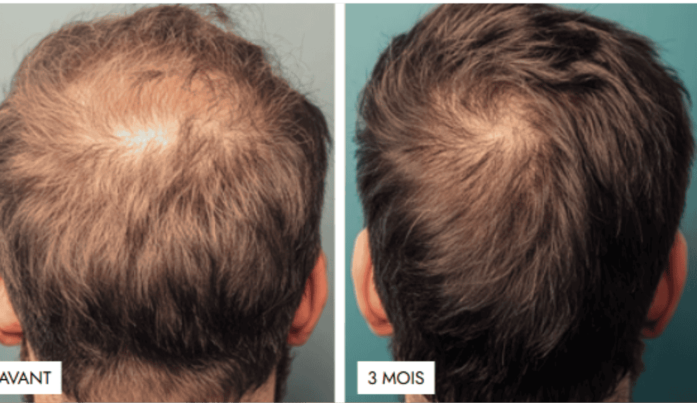 RESULTATS AVANT APRES HAIRNEEDLING_ institut révélation albi