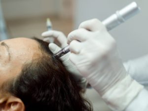 Lire la suite à propos de l’article Micropigmentation capillaire vs Hairneedling : quelle solution choisir contre la perte de cheveux ?