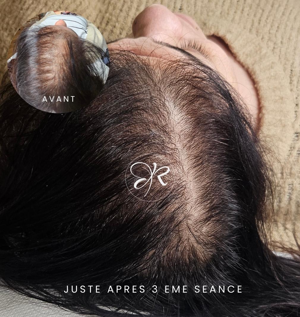 avant après traitement alopécie femme - soin activateur capillaire _ Hairneedling albi