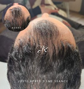 avant après traitement alopécie homme - soin activateur capillaire _ Hairneedling albi