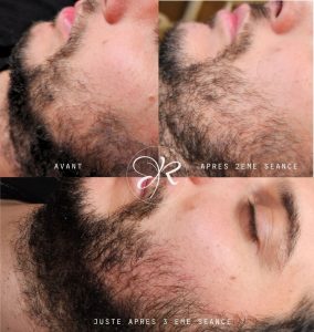 avant après soin densité barbe _ Hairneedling albi - institut révélation