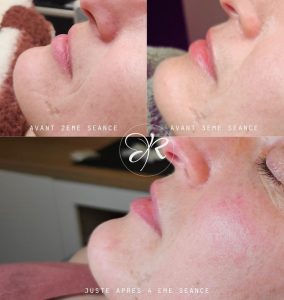 Avant/après traitement rides albi institut révélation