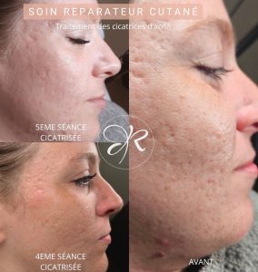 traitement cicatrices d'acné par microneedling